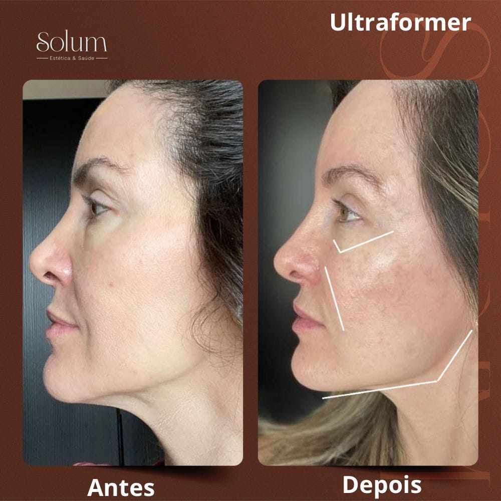 LP Ultraformer - Solum Clinica